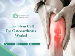 Stem-Cell-Therapy-for-Osteoarthritis-300x225 Osteoarthritis Stem Cell Treatment: A New Frontier in Joint Regeneration
