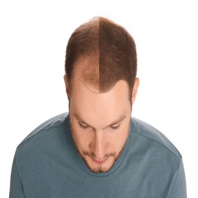 The Science Behind Successful Hair Follicle Grafts at Enfield Clinic