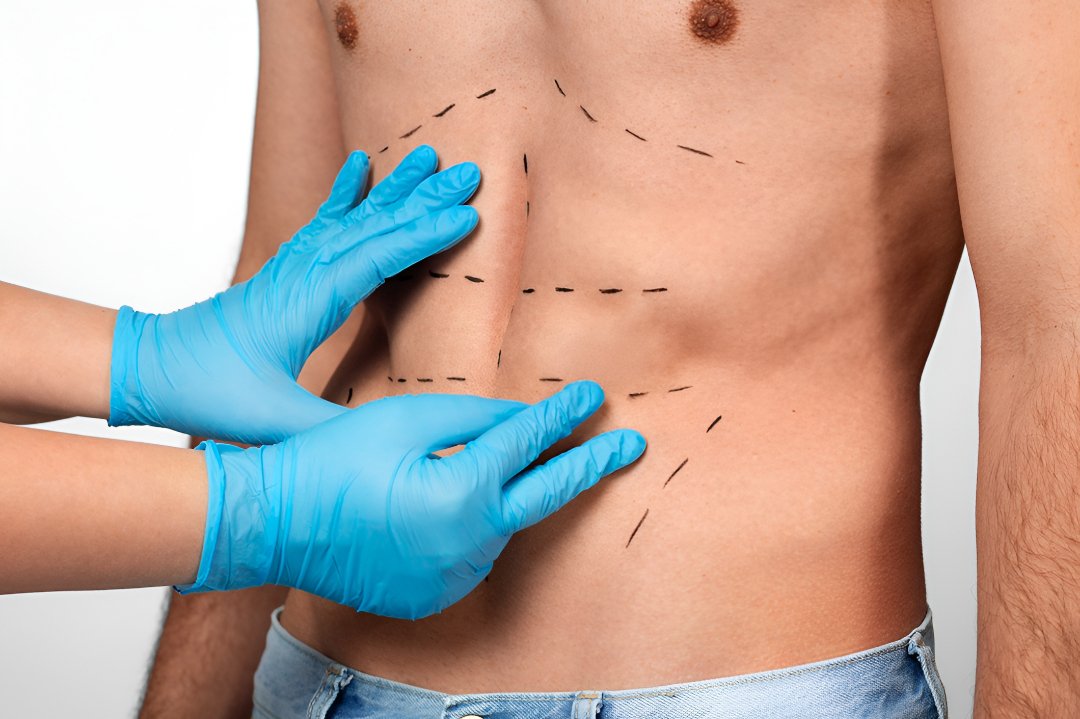 liposuction surgery in Islamabad