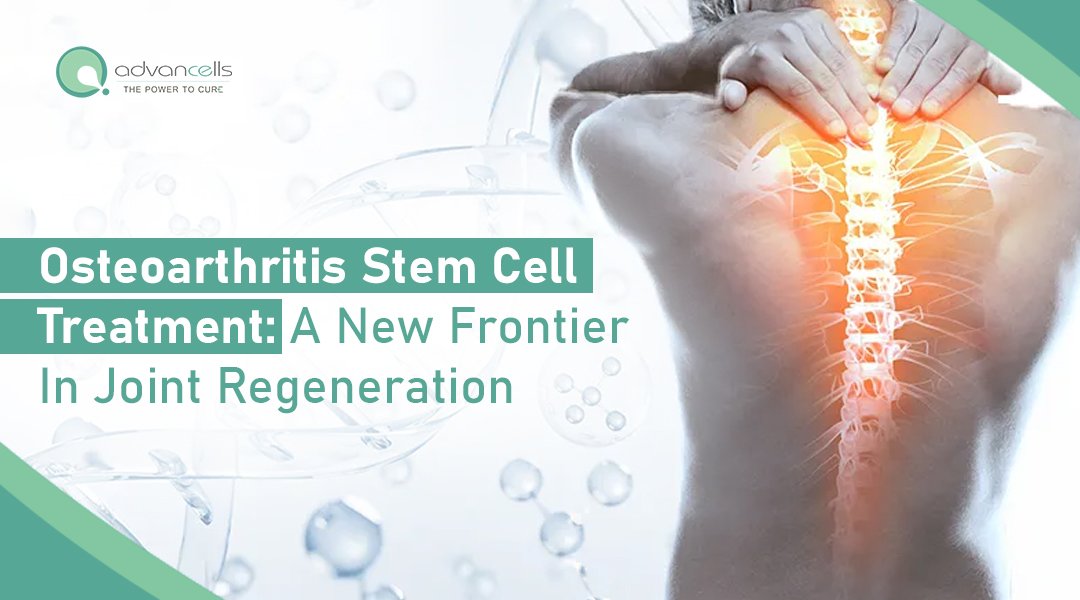 Osteoarthritis-Stem-Cell-Treatment