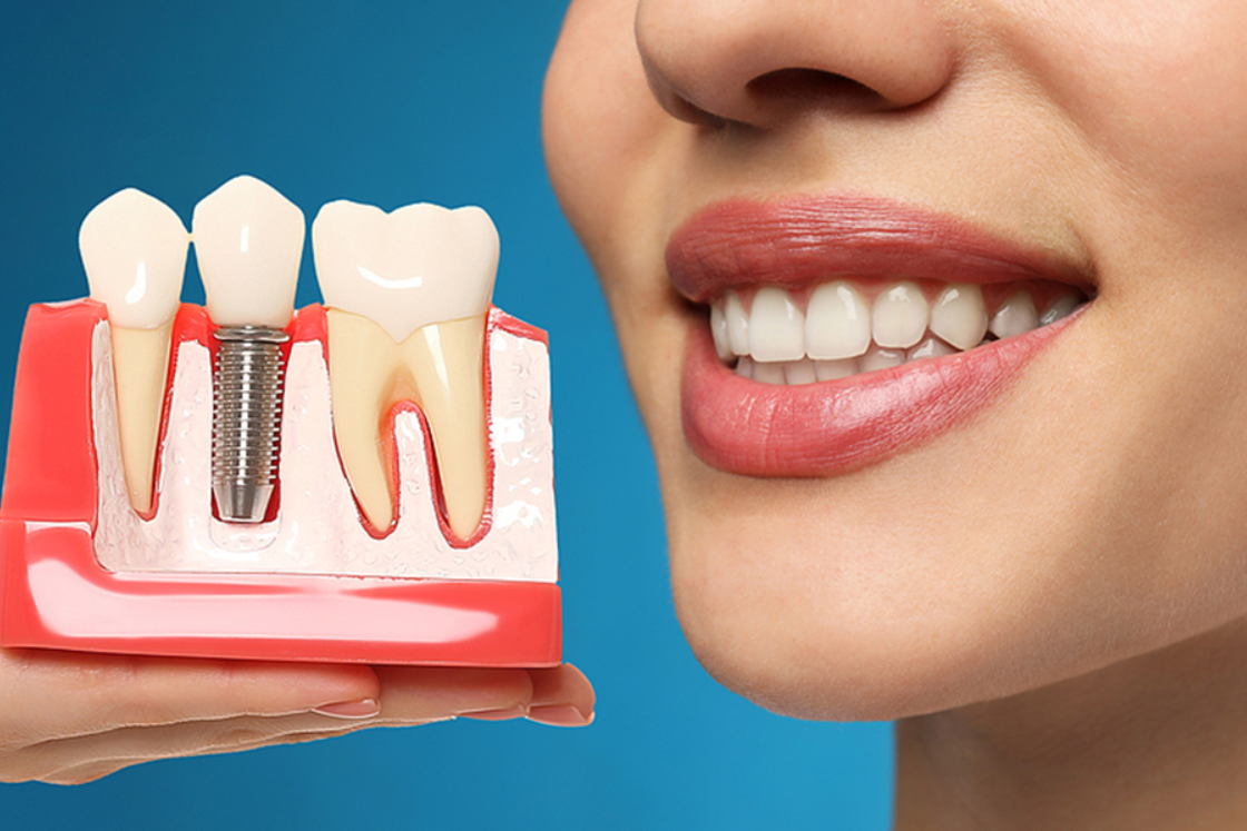 Dental Implants