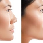 Deep Clinical Insight into Surgical Planning, Outcomes, and Functional Rehabilitation Jaw Surgery in Islamabad Pakistan: