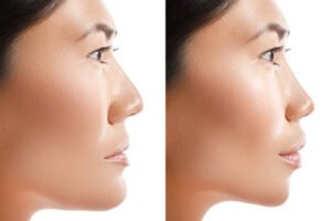 Deep Clinical Insight into Surgical Planning, Outcomes, and Functional Rehabilitation Jaw Surgery in Islamabad Pakistan: