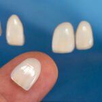 Common Mistakes Patients Should Avoid Before Treatment Dental Veneers in Islamabad Pakistan: