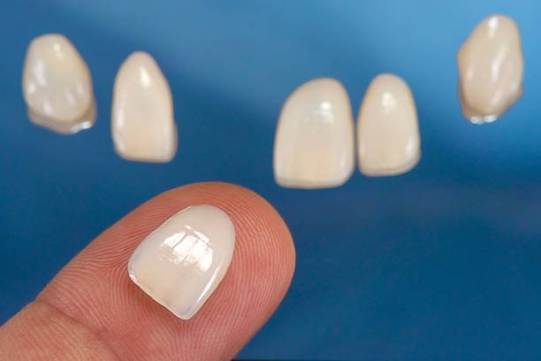Common Mistakes Patients Should Avoid Before Treatment Dental Veneers in Islamabad Pakistan: