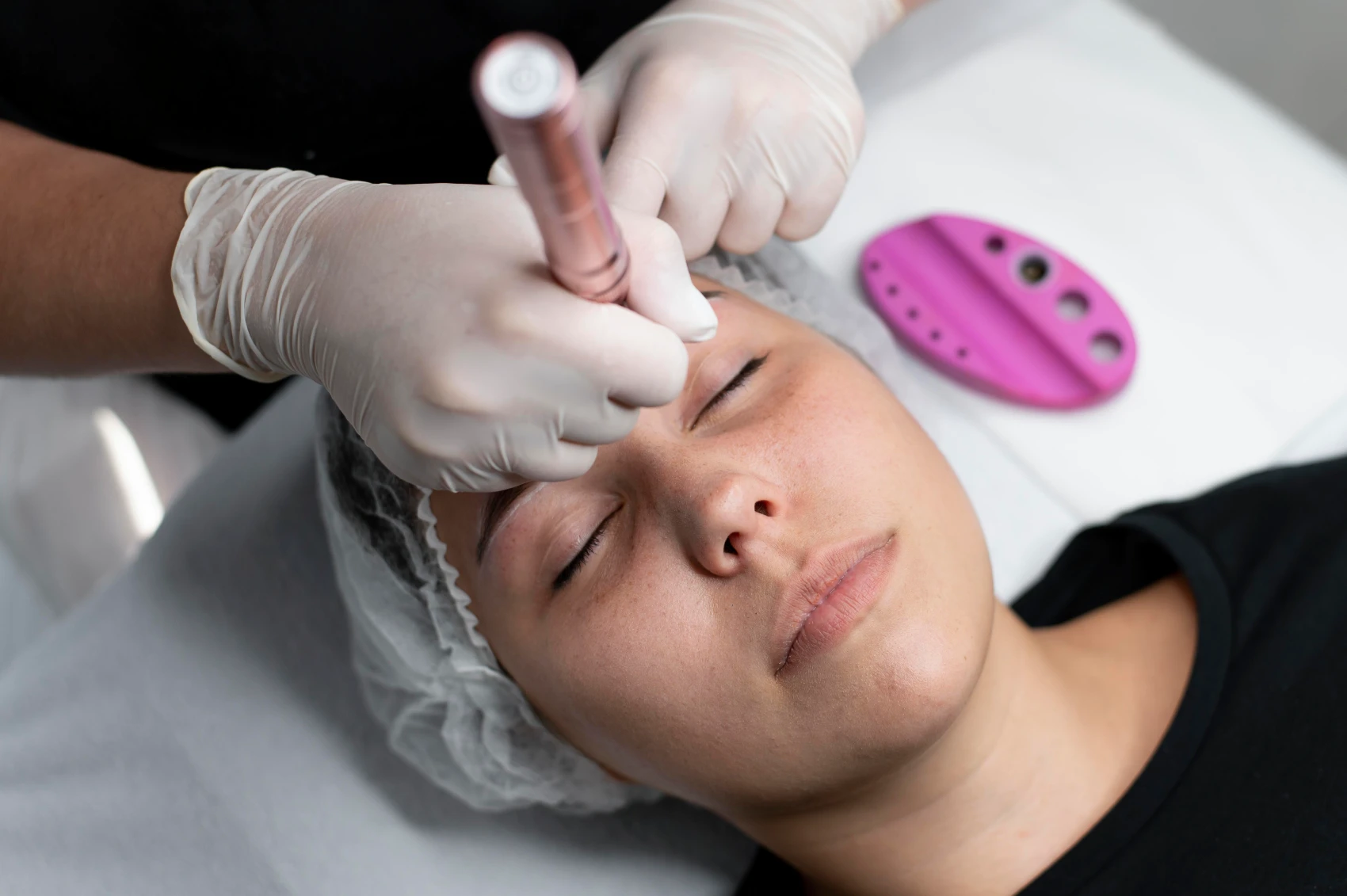 microneedling for acne scarring Toronto