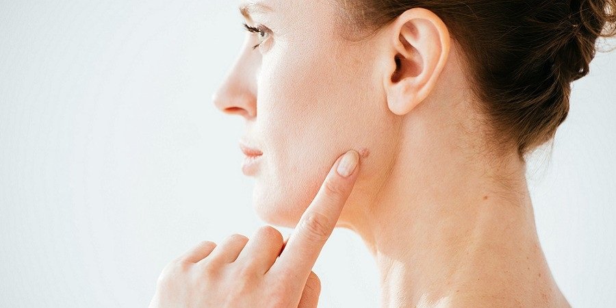 mole removal in islamabad pakistan