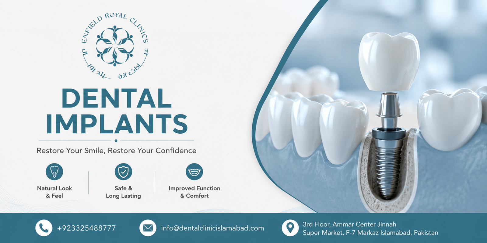 Best Dental Implants in Islamabad