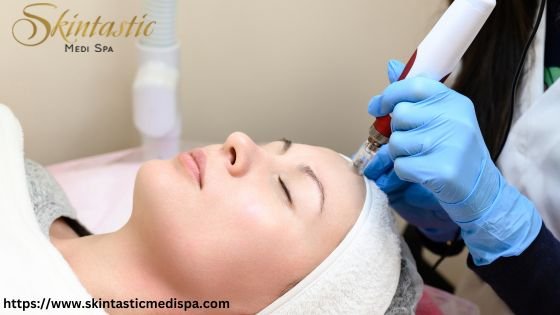 Potenza Microneedling Near Me