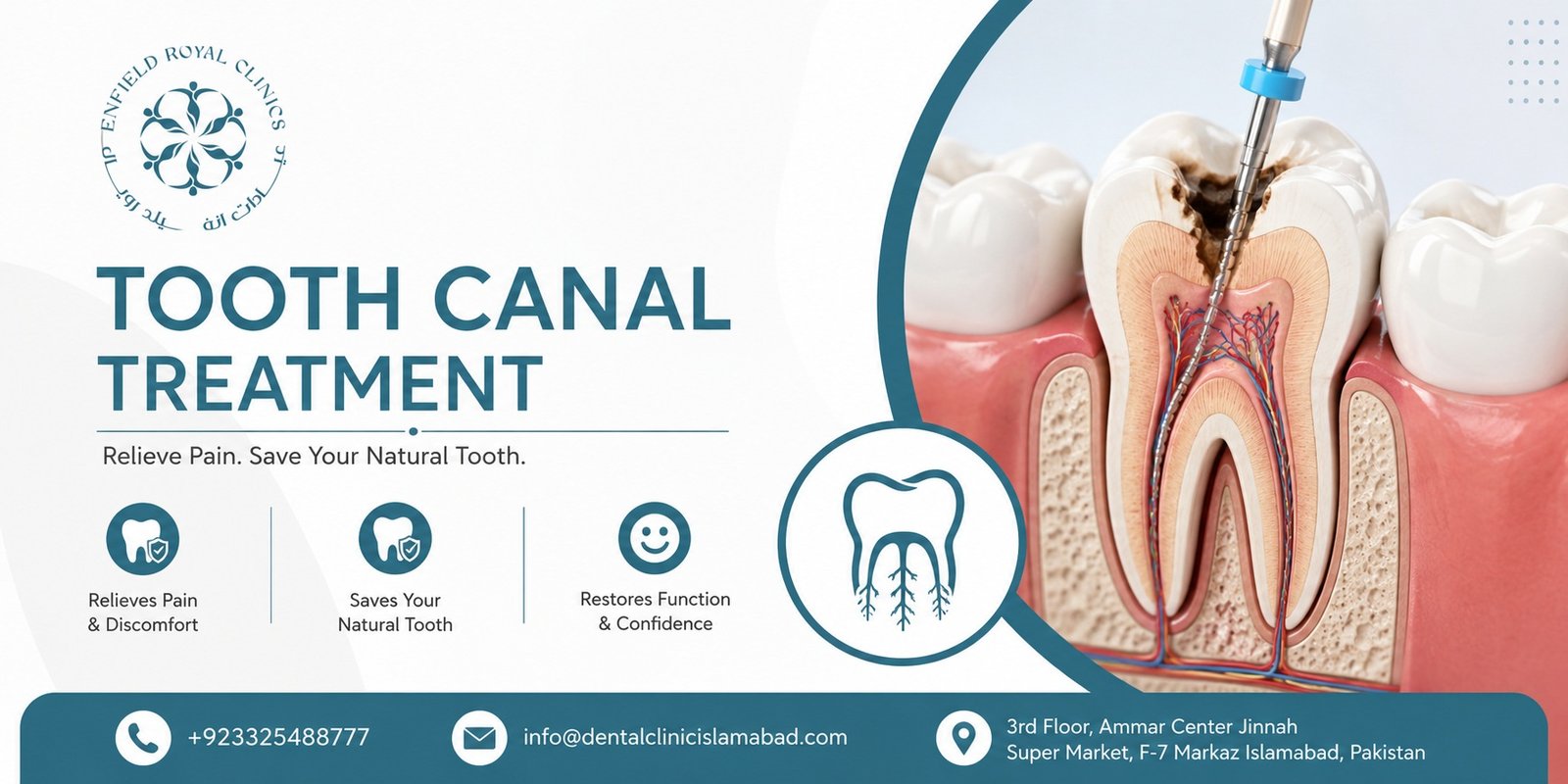 Tooth Canal Treatment in Islamabad