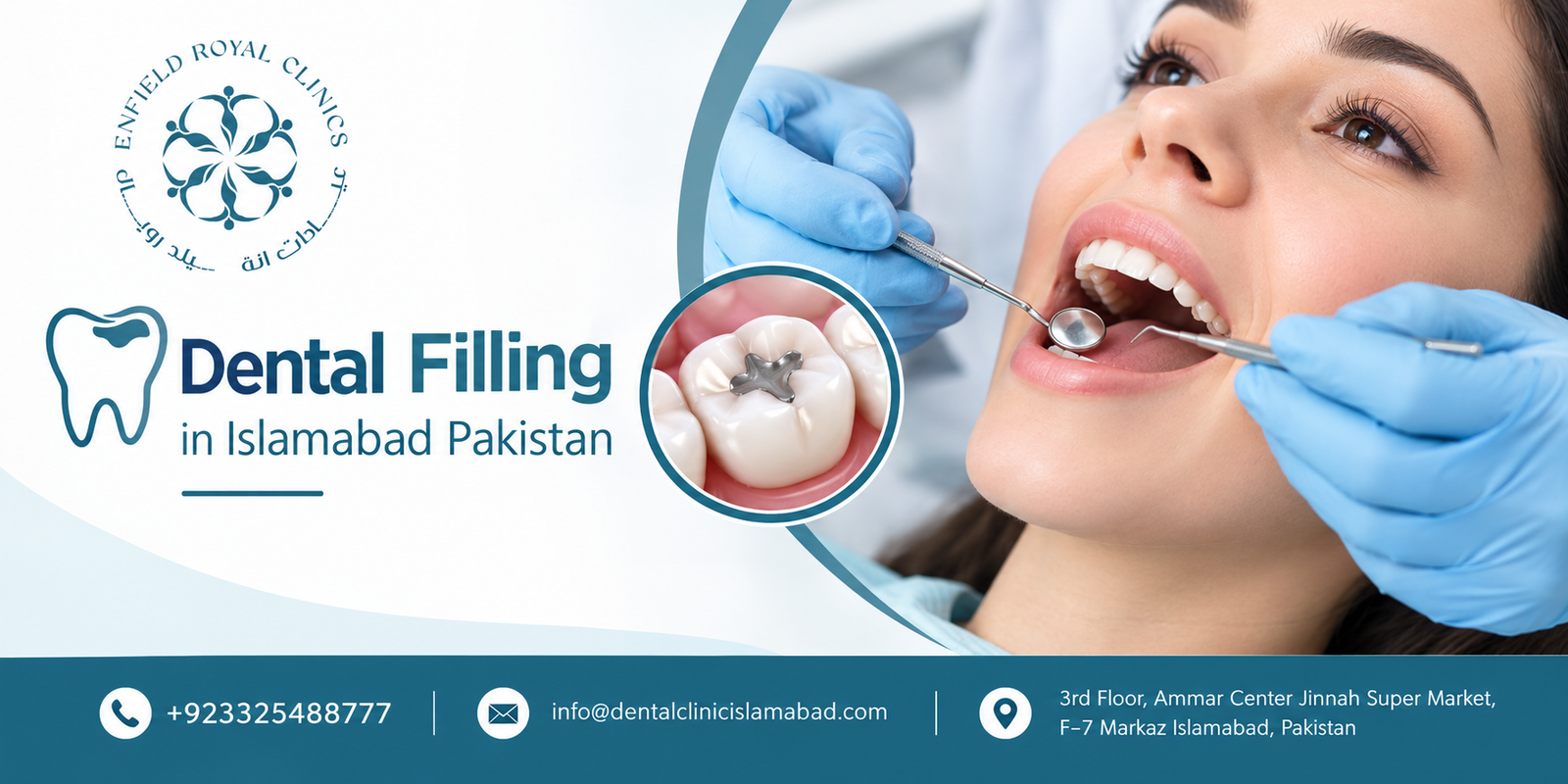 Dental Filling in Islamabad